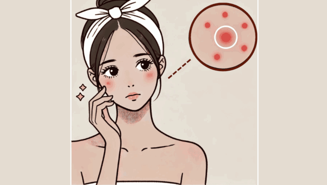 頬にニキビができて悩んでいる女性。