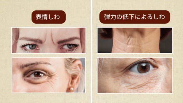 表情じわと弾力の低下によるしわ