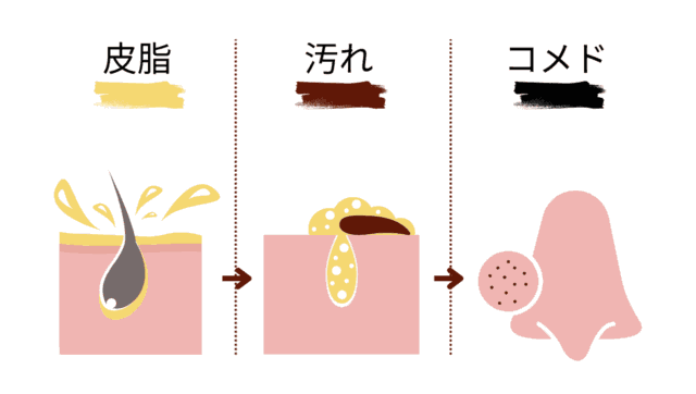 小鼻の毛穴が黒ずむメカニズムを皮脂の分泌から酸化、汚れの付着までを段階的に図解したイラスト。